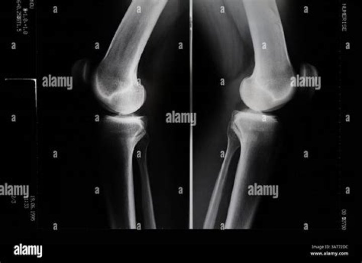KneeCaps