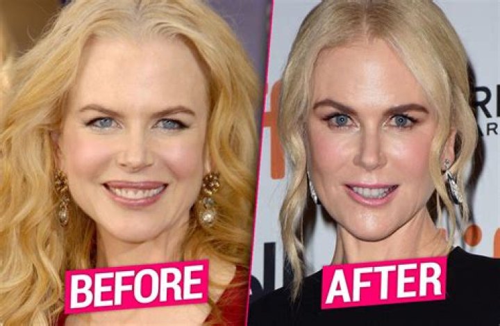 Nicole Kidman Facelift